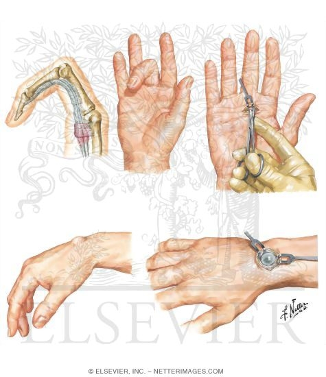 Stenosing Tenosynovitis of Flexor Tendons of Fingers (Trigger Finger)
Ganglion of Wrist