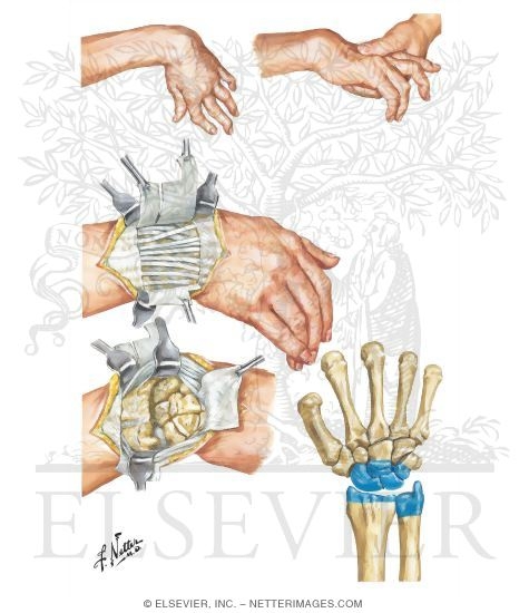 Implant Resection Arthroplasty for Radiocarpal Joint