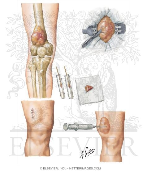 Tumor Biopsy