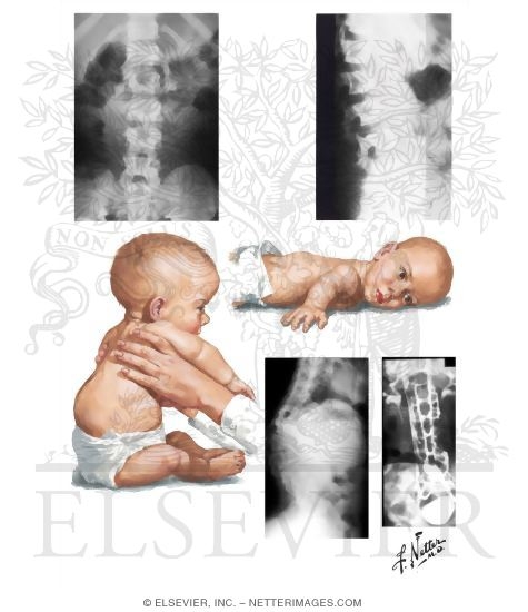 Achondroplasia