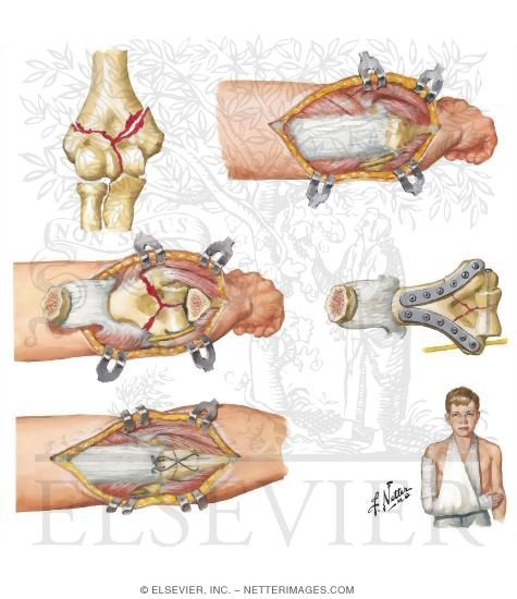 Intercondylar (T or Y) Fracture of Elbow Joint