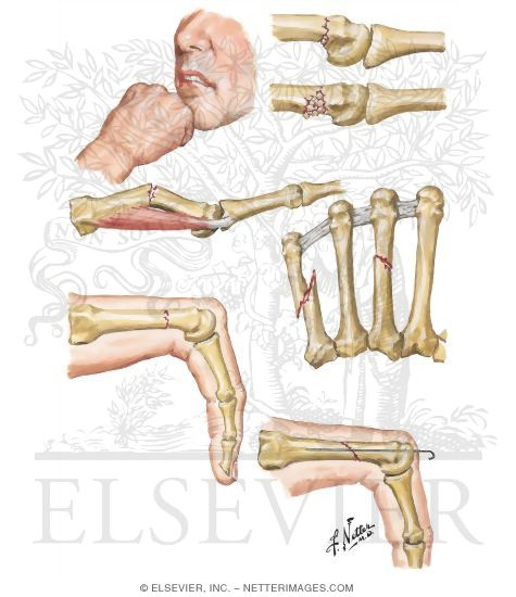 Fracture of Metacarpals