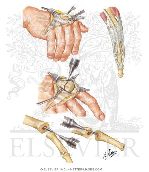 Implant Resection Arthroplasty for Metacarpophalangeal Joints