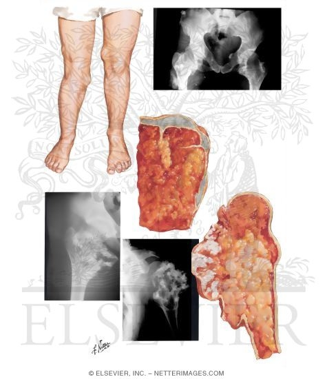 Osteocartilaginous Exostosis (Osteochondroma)