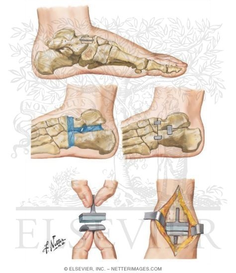 Surgical Procedures for Hindfoot Deformities