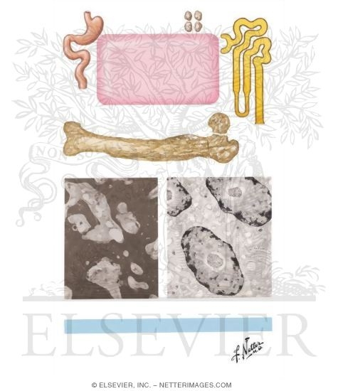 Pathogenesis and Treatment of Paget Disease of the Bone