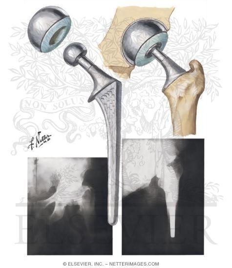 Bipolar Prosthesis for Hemiarthroplasty of Hip