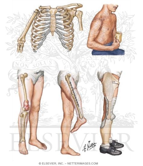 Tikhoff-Linberg Procedure for Tumors of Scapula and Proximal Humerus, Rotationplasty for Sarcoma of Distal Femur
