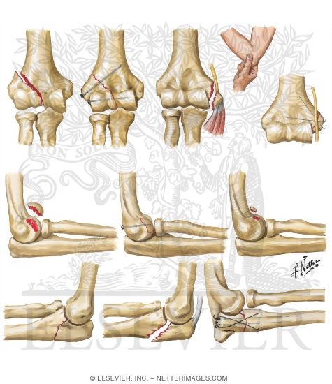 Fracture of Condyle, Epicondyle, Capitulum, and Olecranon