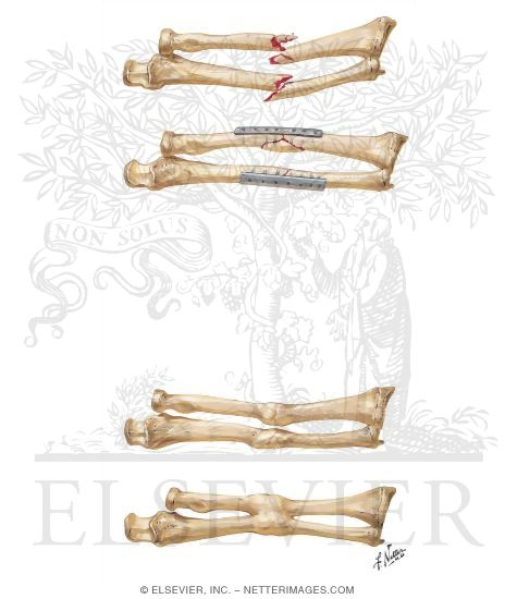 Fracture of Both Forearm Bones