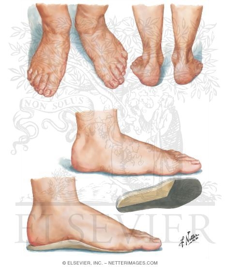Hindfoot Deformities in Rheumatoid Arthritis