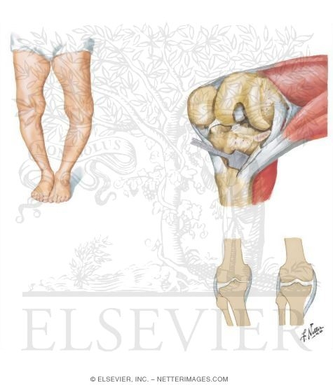 Medial Release for Varus Deformity of Knee