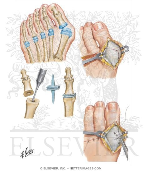 Silicone Implant Resection Arthroplasty for Rheumatoid Forefoot