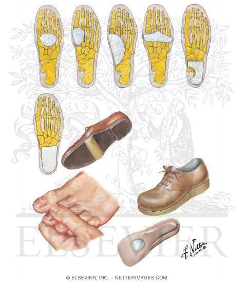 Conservative Management of Rheumatoid Foot Deformities