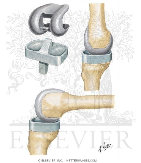 Prothesis knee