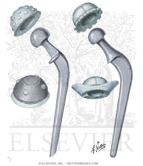 Prostheses for Total Hip Replacement