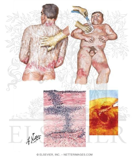 Prevention of Infection in Burn Wounds