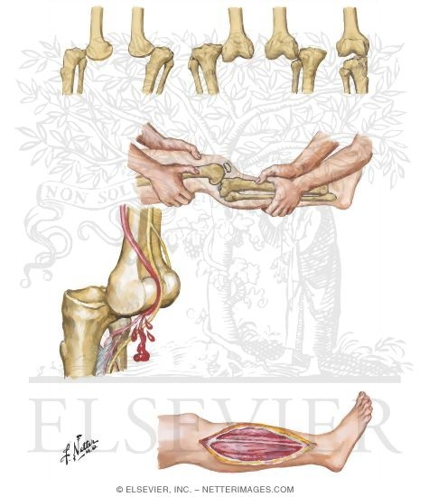 Dislocation of Knee Joint. Other Versions of This Illustration