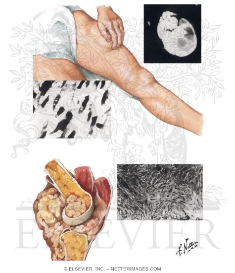 Malignant Fibrous Histiocytoma