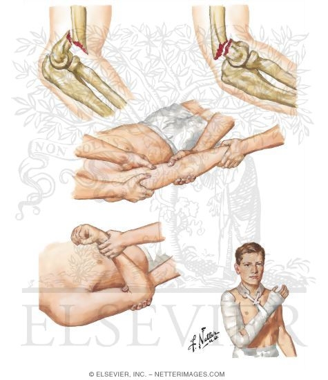 Supracondylar Fracture of Humerus