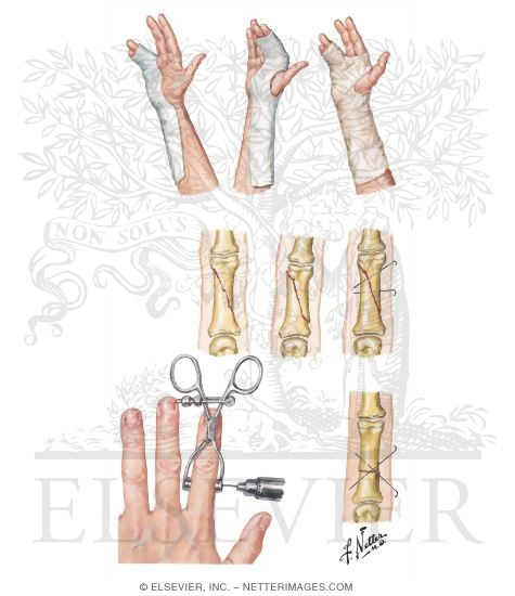 Management of Fracture of Proximal and Middle Phalanges