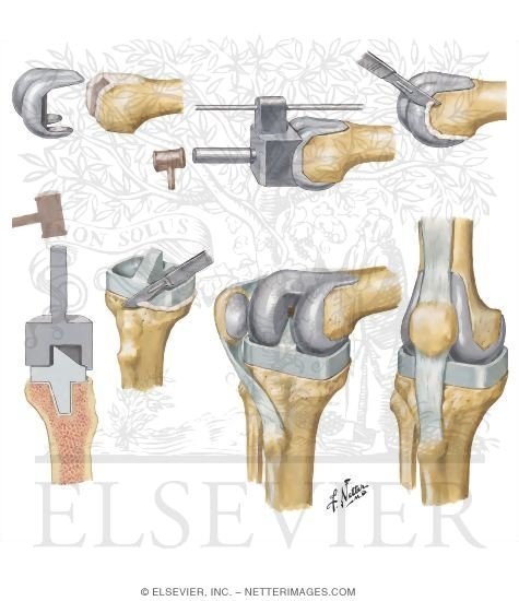 Total Knee Arthroplasty