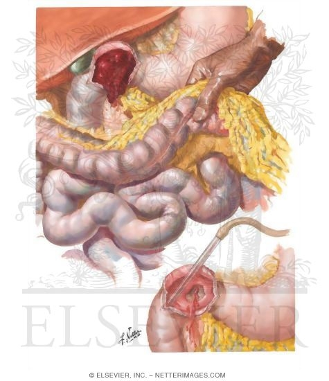Peptic Ulcer VIII - Complications of Gastric and Duodenal Ulcers