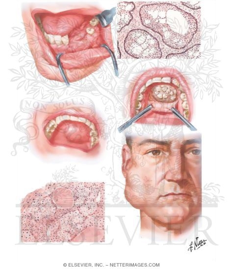 Benign Tumors of Oral Cavity