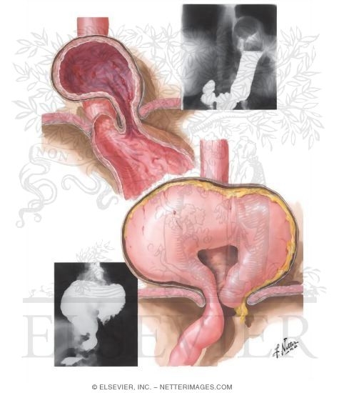 Thoracic Stomach II - Paracardial Hernia