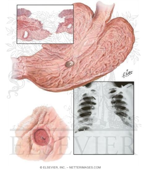 Peptic Ulcer VIII - Complications of Gastric and Duodenal Ulcers