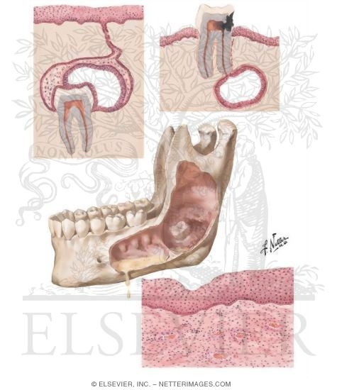 Cysts In Mouth
