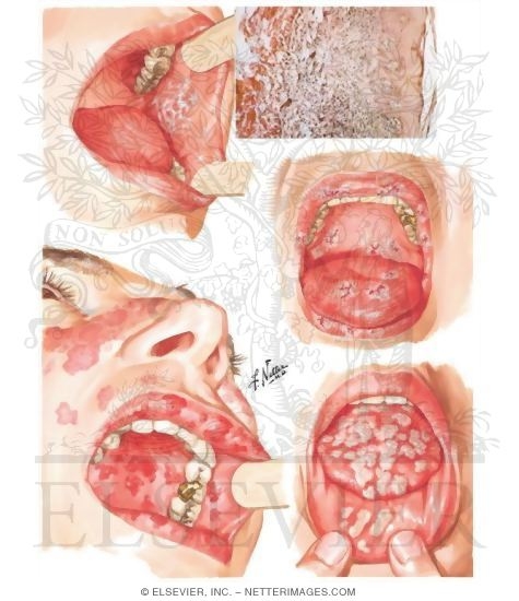 Oral Manifestations in Various Skin Conditions