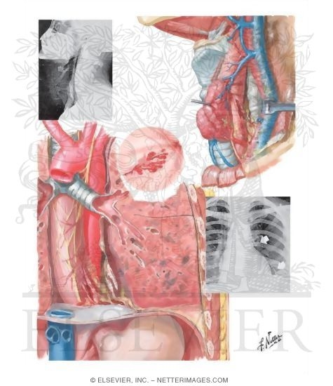 Esophageal Rupture and Perforation