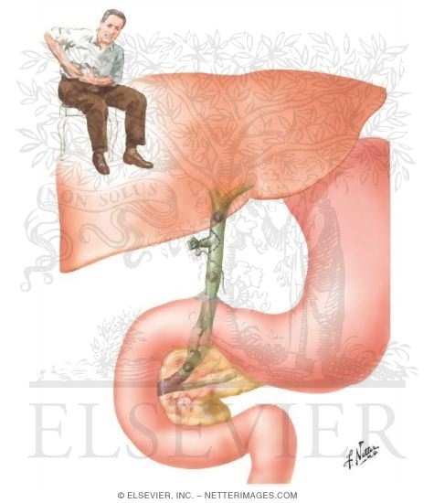 Postcholecystectomy Syndrome