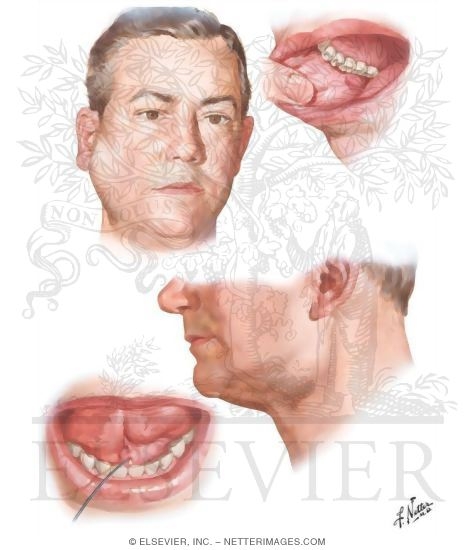 Inflammations of Salivary Glands