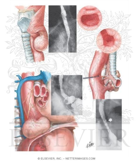 Diverticula