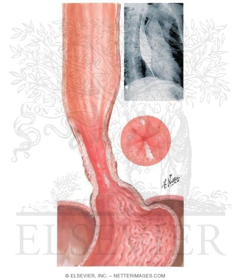 Esophagitis, Esophageal Ulcers - Peptic Esophagitis