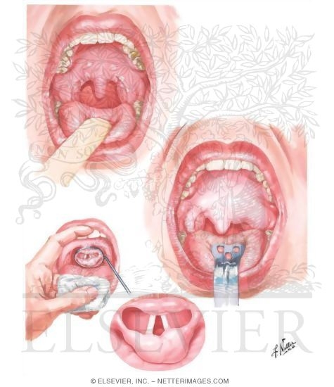 Allergic Conditions of Pharynx
