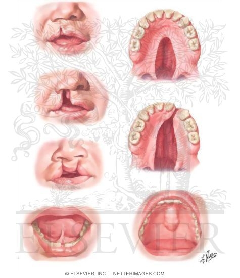 Congenital Anomalies of Oral Cavity