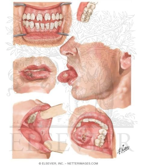 Syphilis of Oral Cavity