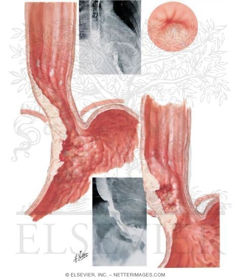 Malignant Tumors: Lower End of Esophagus