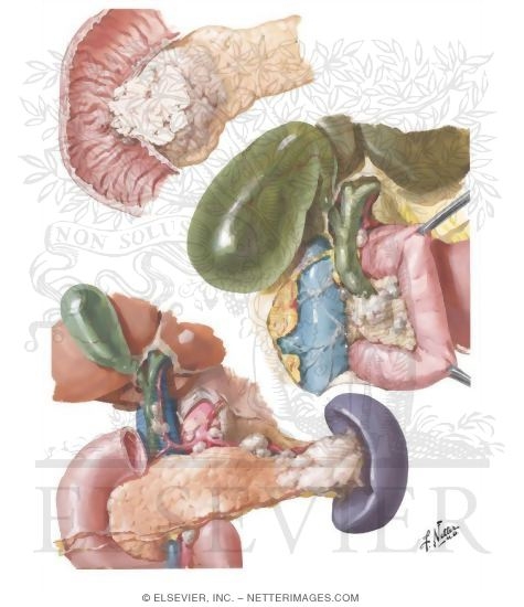 Malignant Tumors II - Carcinoma, Gross Pathology and Clinical Features