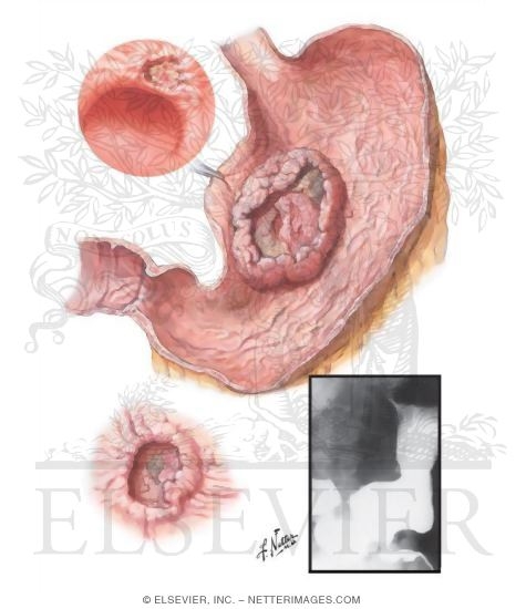 Carcinoma of Stomach - Ulcerating Carcinoma