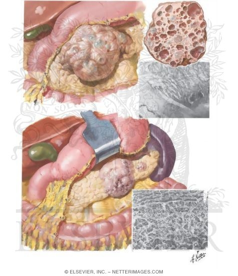 Malignant Tumor
