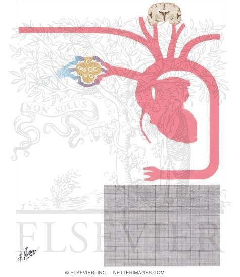 Aortic Stenosis