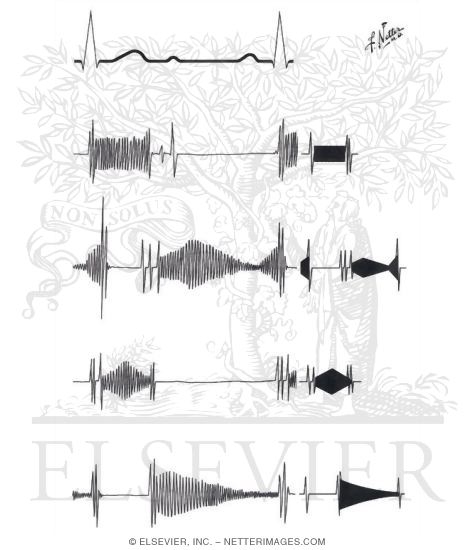 Phonocardiograms of Valvular lesions