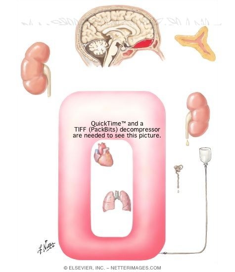 Salt and Water Balance In Head Injury