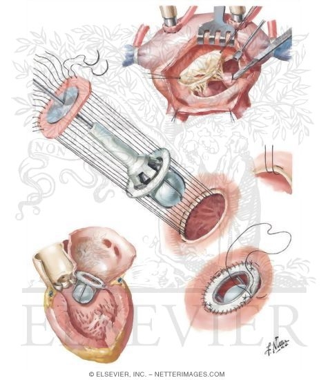 Mitral-Valve Replacement. Other Versions of This Illustration