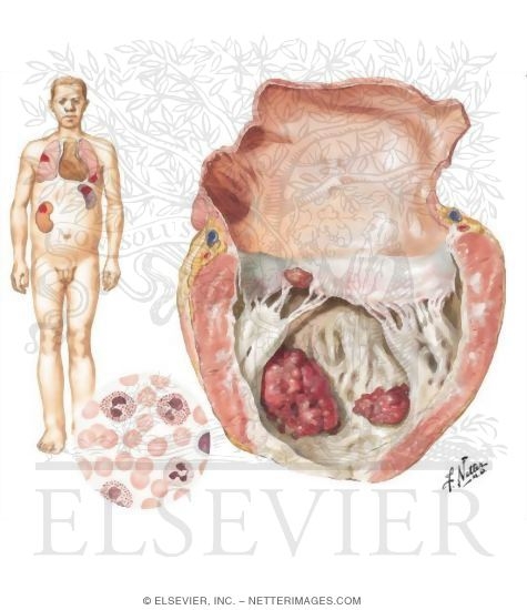 Loffler's Disease