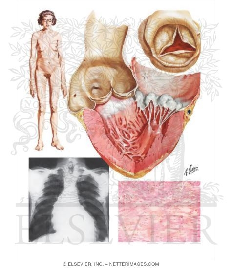 Cystic Medial Necrosis of the Aorta
